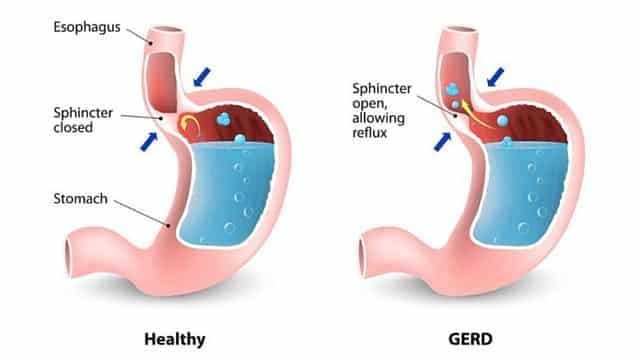 Heartburn Relief 1