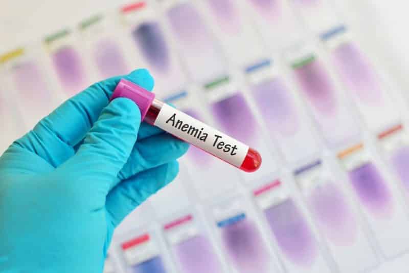 anemia