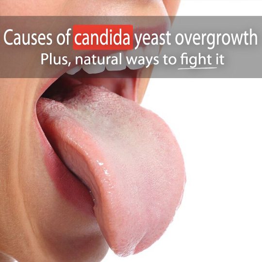 Are you prone to yeast infections or oral thrush? Find out the causes of Candida overgrowth and how to naturally fight it!
