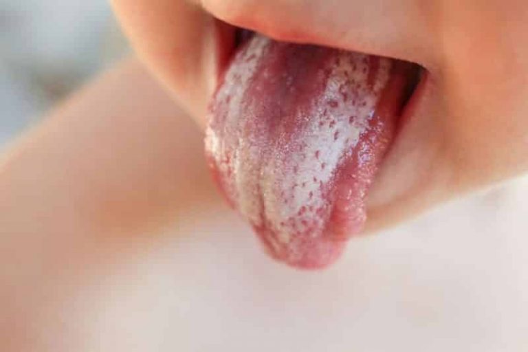 Causes of Candida Yeast Overgrowth + How To Fight It