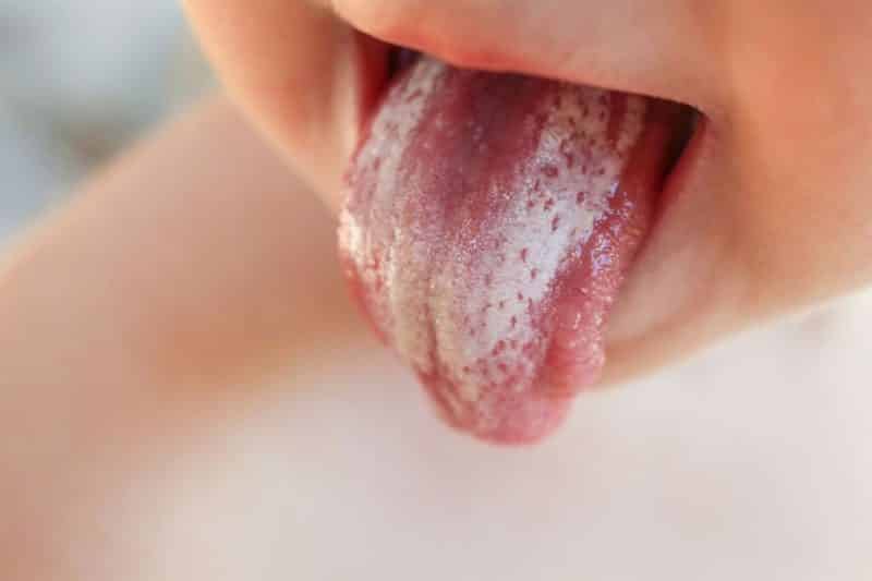 oral thrush