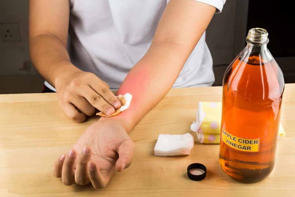 ACV for skin irritations